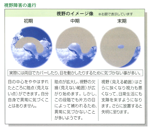 圧 と 眼 どうなる 高い が